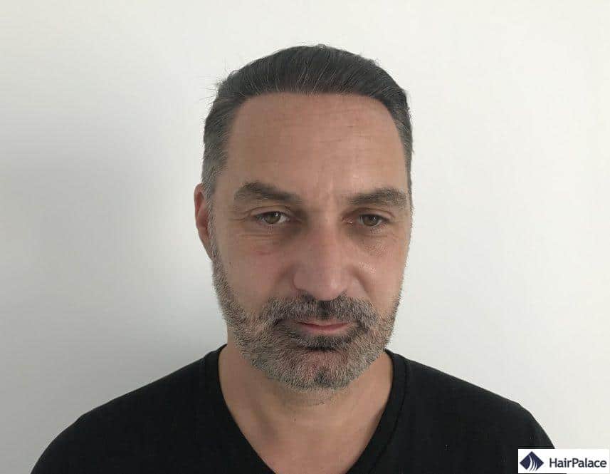 1 year after hair transplant 1