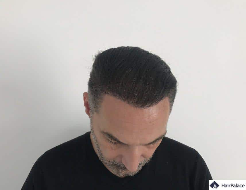 1 year after hair transplant 2