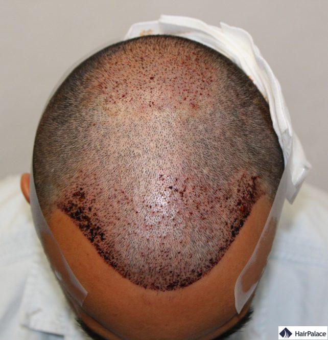 6000 cheveux distribués sur deux zones