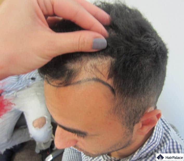 La Greffe De Cheveux De Yohann 6000 Cheveux Implantes Avec Fue2 La Greffe De Cheveux De Yohann 6000 Cheveux Implantes Avec Fue2