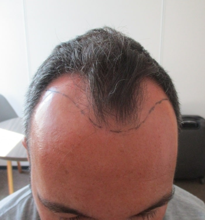 La greffe de cheveux de Jérôme - la correction de la ligne frontale