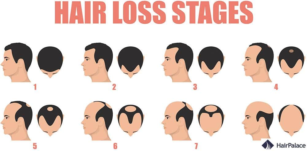 les stades de la calvitie masculine