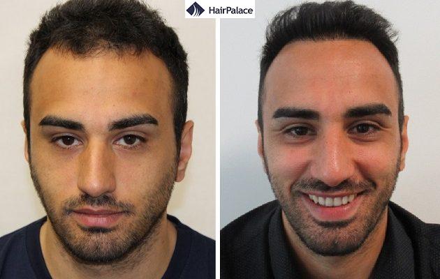 La greffe de cheveux est-elle permanente