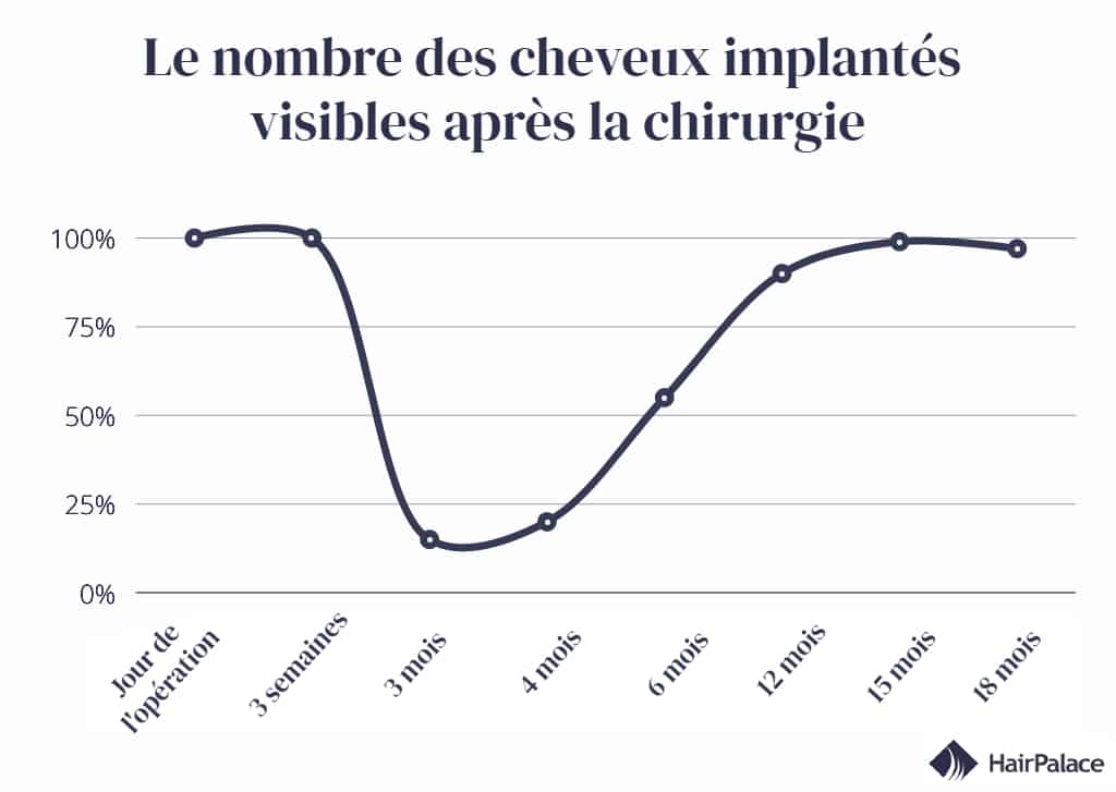 chronologie de la quantité de cheveux implantés visibles après la greffe de cheveux