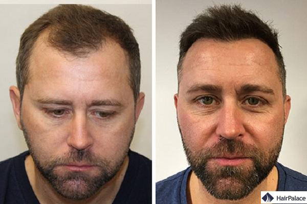 avant et 1 année après sa greffe de cheveux Neil