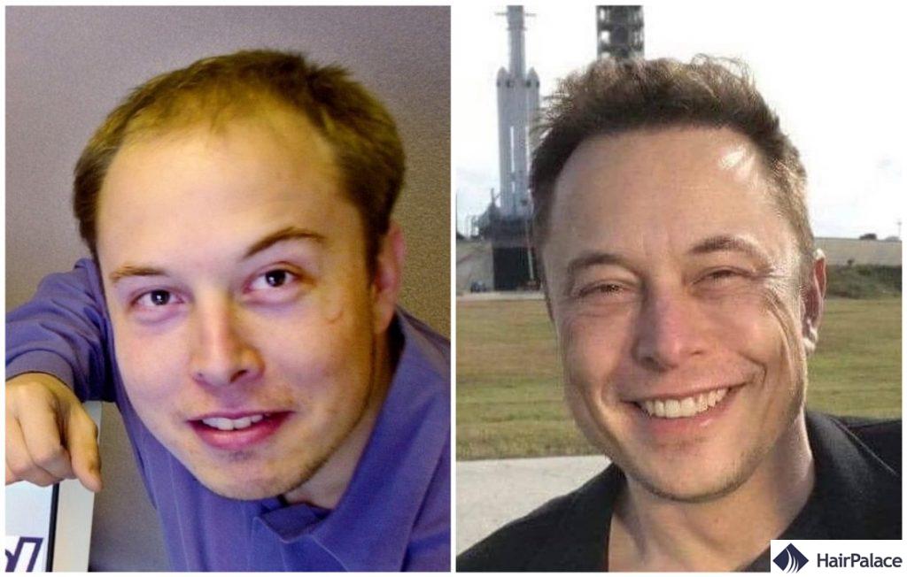 Elon Musk avant et après la greffe de cheveux
