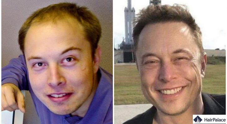 Elon Musk avant et après la greffe de cheveux