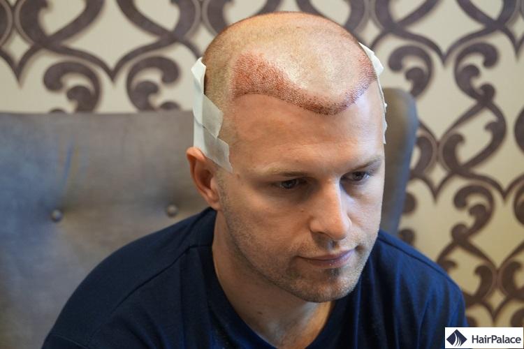 Peter après la FUE2 greffe de cheveux