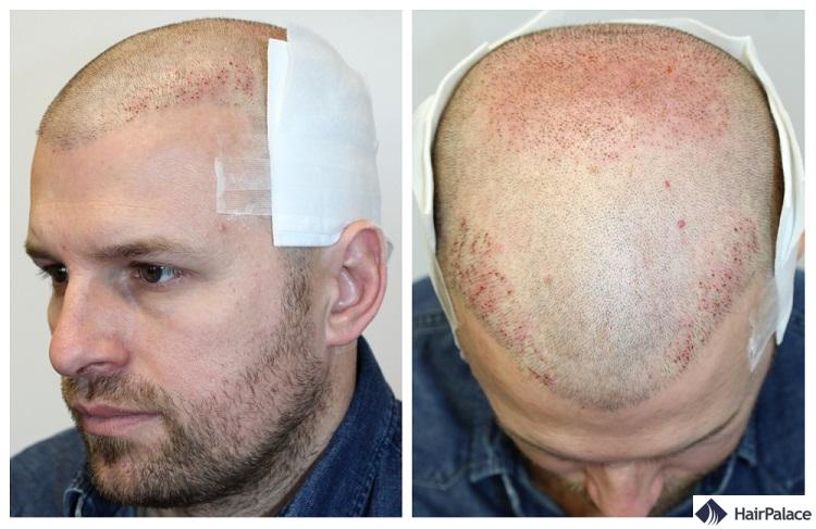 Il a reçu 5096 cheveux au total