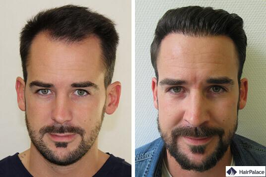 résultat de la greffe de cheveux maxime