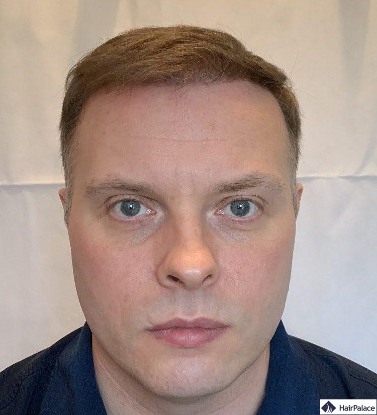 Résultat à 6 mois implant capillaire