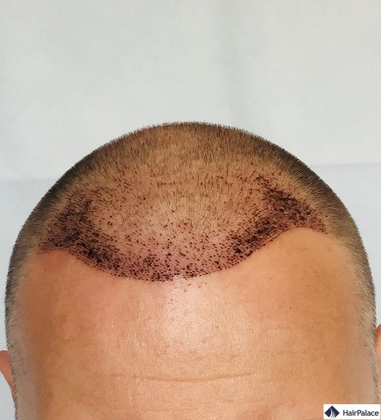 Résultat sur 1 semaine implant capillaire