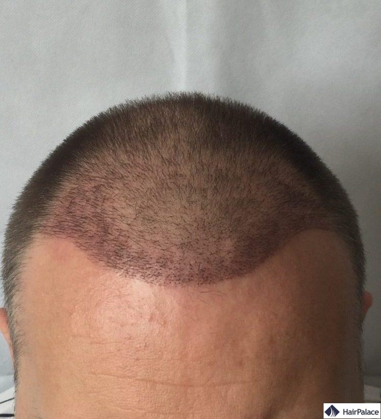 Résultat sur 3 semaine implant capillaire