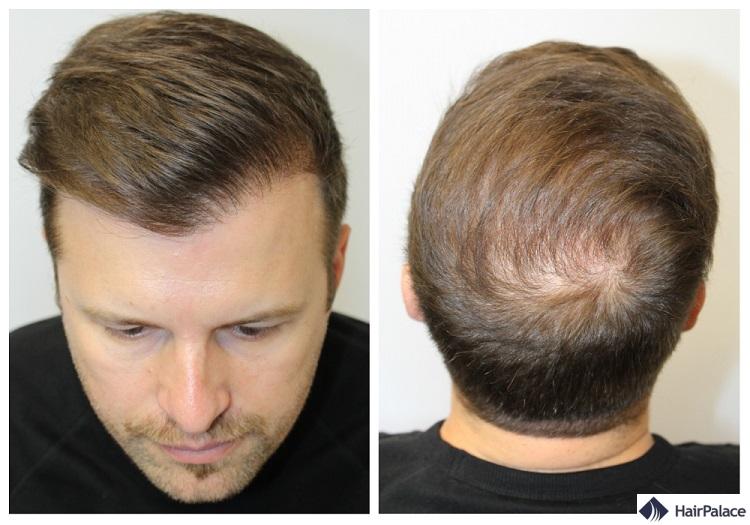 Peter résultat de la greffe de cheveux