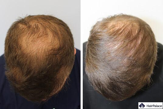 implantation capillaire réussie de péter