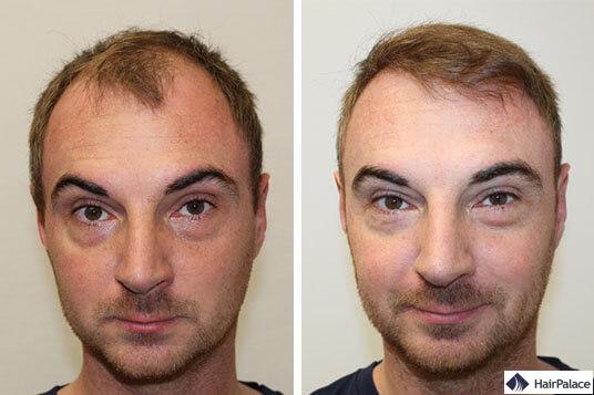 Résultat de la greffe de cheveux Alex
