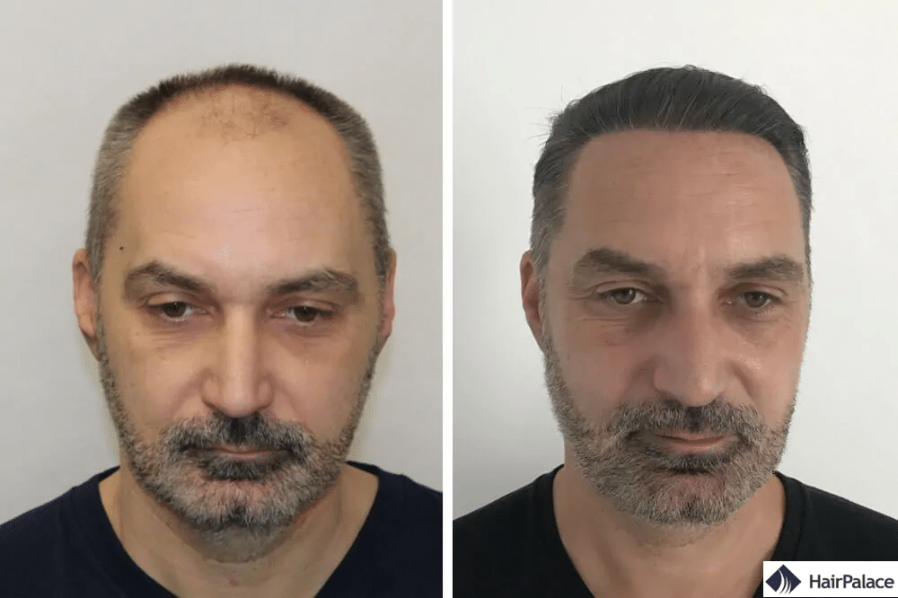 implantation de cheveux réussie