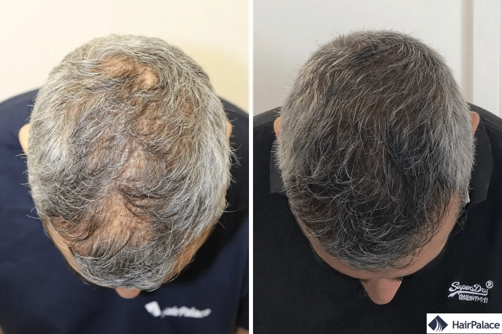Avant et après la greffe de cheveux
