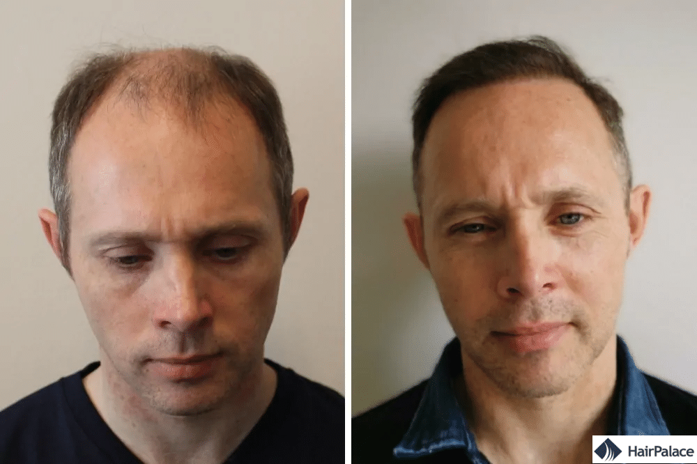 méthode fue2 greffe de cheveux