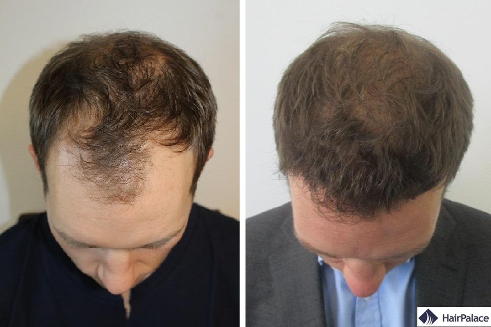 méthode fue2 greffe de cheveux