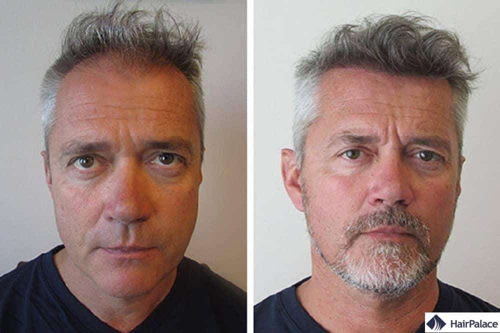 Résultat de la méthode d'implantation capillaire