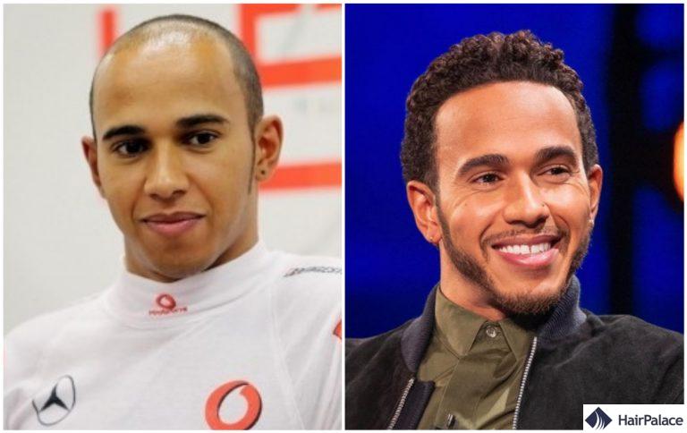 Lewis Hamilton résultat greffe de cheveux