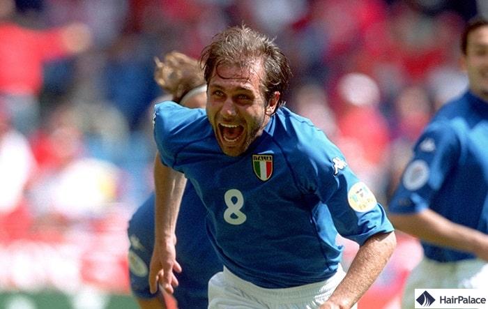 Greffe de cheveux Antonio Conte en 2000