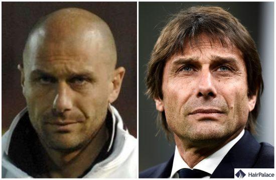 Antonio Conte avant et après la greffe de cheveux