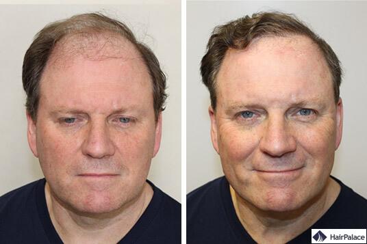 implant capillaire avant et après