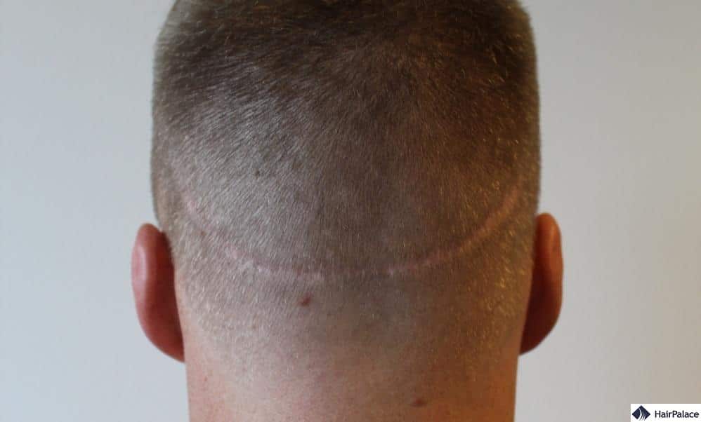 cicatrice après greffe de cheveux avec fut
