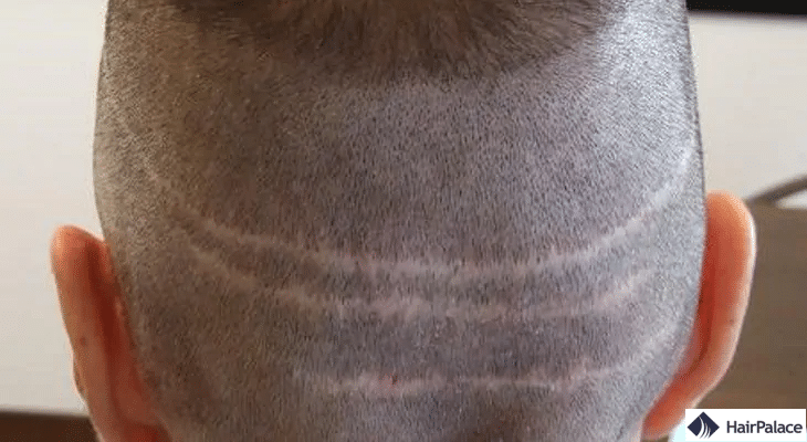 Cicatrices aprés greffe de cheveux