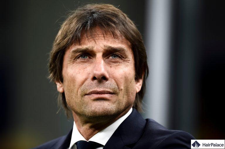 Antonio Conte avant et après la greffe de cheveux FUE