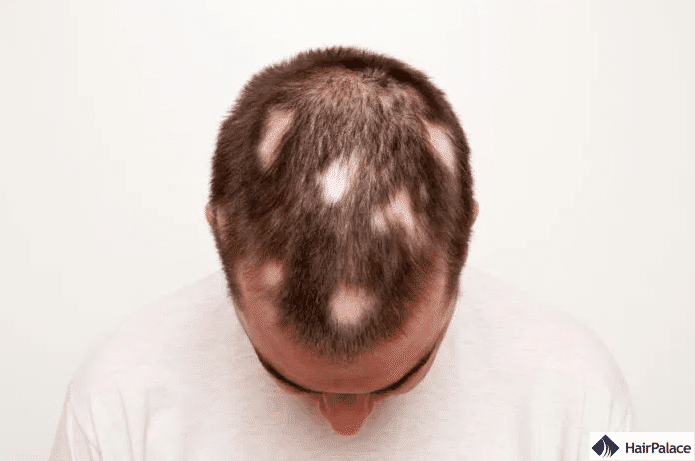 l'alopécie areata entraîne la chute des cheveux par plaques