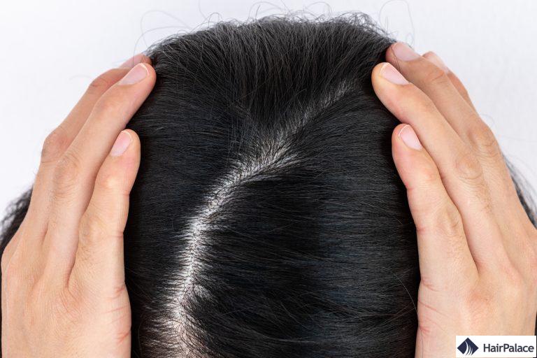 la perte génétique de cheveux peut entraîner un élargissement de la zone de cheveux qui s’éclaircissent