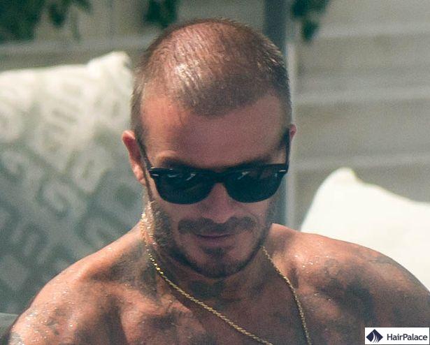 La perte de cheveux de David Beckham à la quarantaine