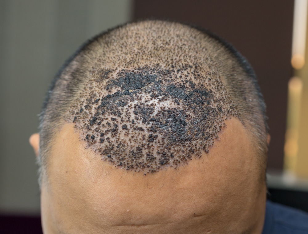 les croûtes importantes peuvent augmenter votre risque d'infection après une greffe de cheveux