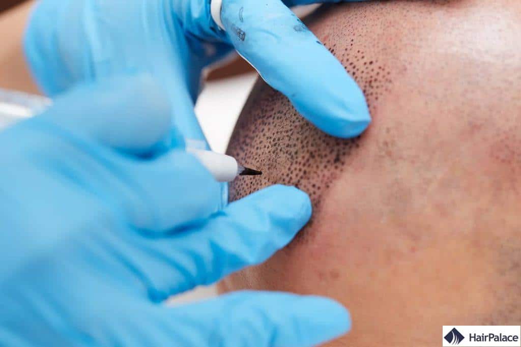 micropigmentation du cuir chevelu avec un appareil de tatouage électrique