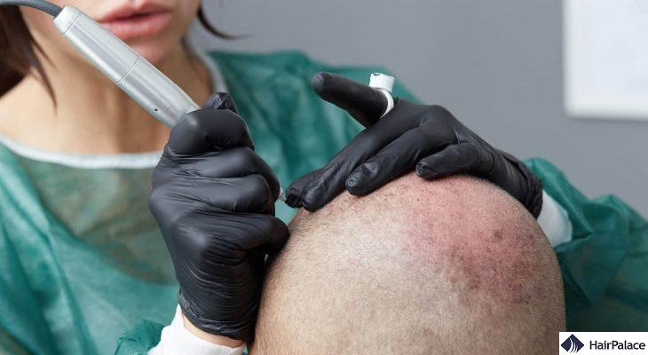 micropigmentation du cuir chevelu pour la perte de cheveux