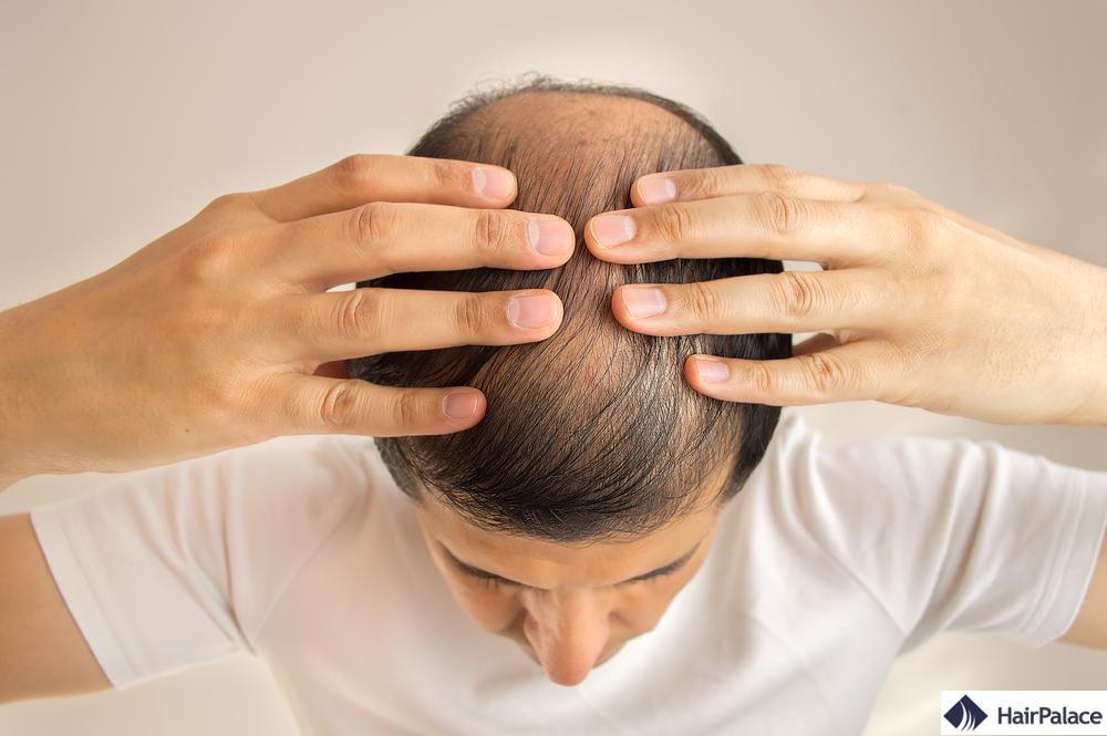 perte de cheveux