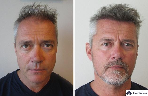 Greffe de cheveux en Turquie