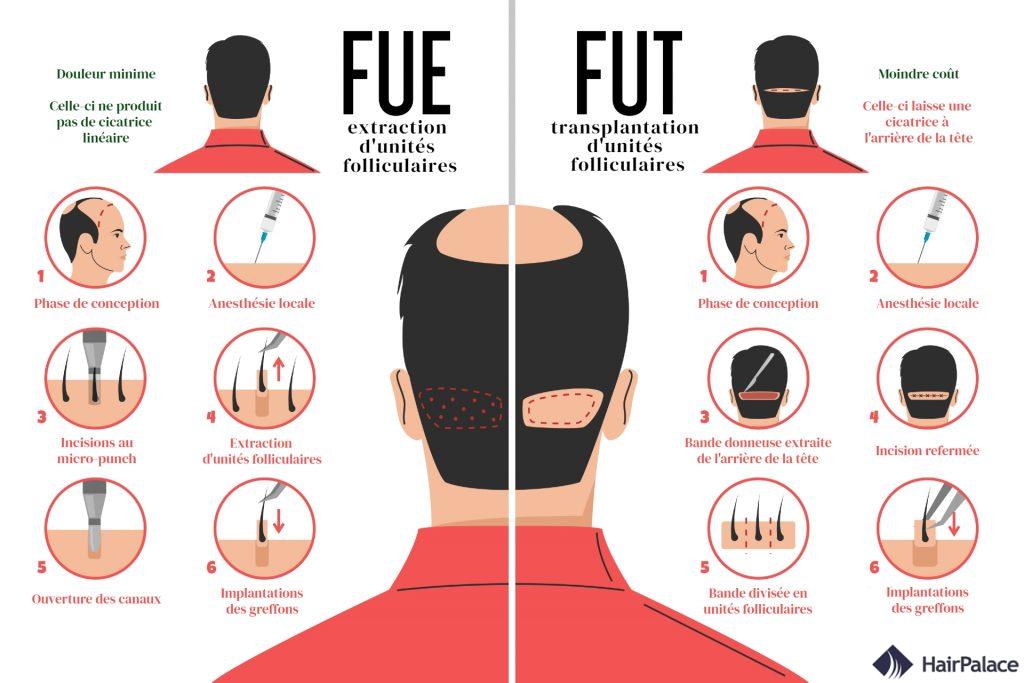 FUE vs FUT greffe de cheveux