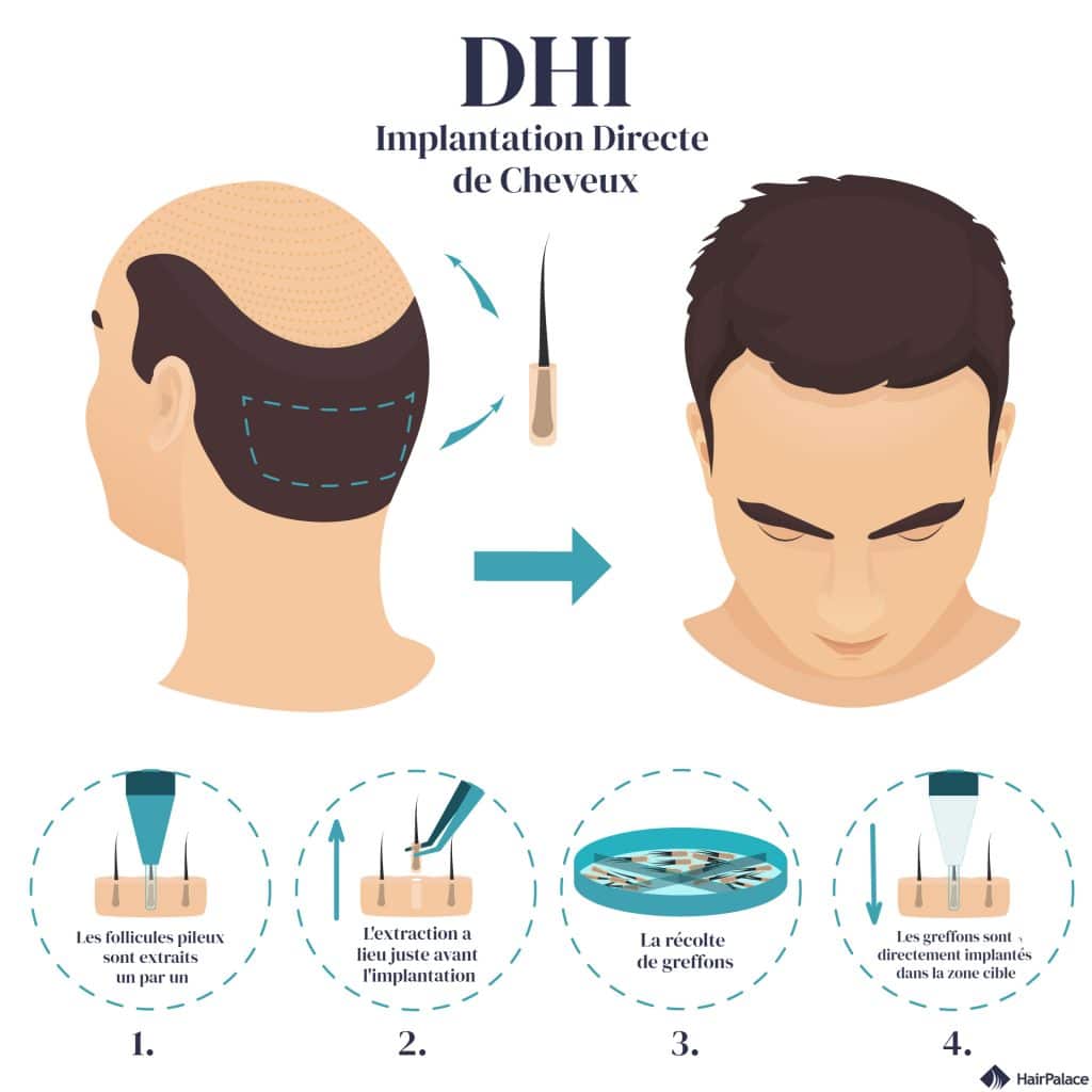 La greffe de cheveux par DHI