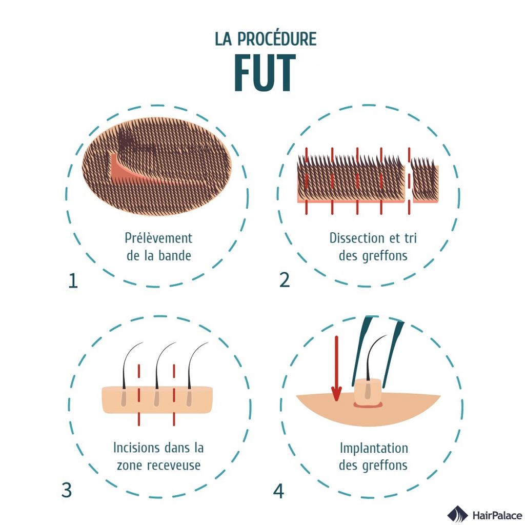 FUT greffe de cheveux