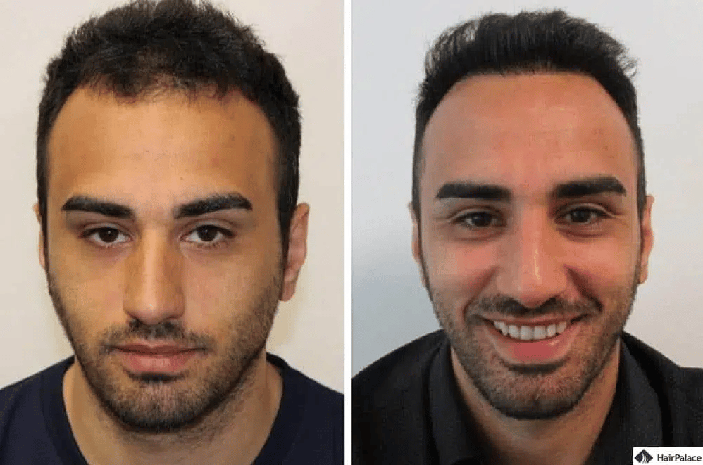 La greffe de cheveux à Istanbul : le TOP 10 des cliniques