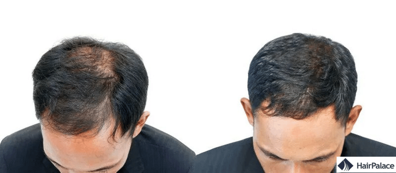 PRP cheveux : avant et après