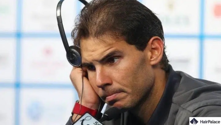 La greffe de cheveux de Rafael Nadal : réussite ou échec ?