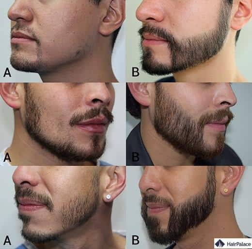 avantages et les inconvénients d’une greffe de barbe
