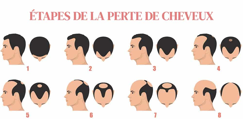 stades de perte de cheveux