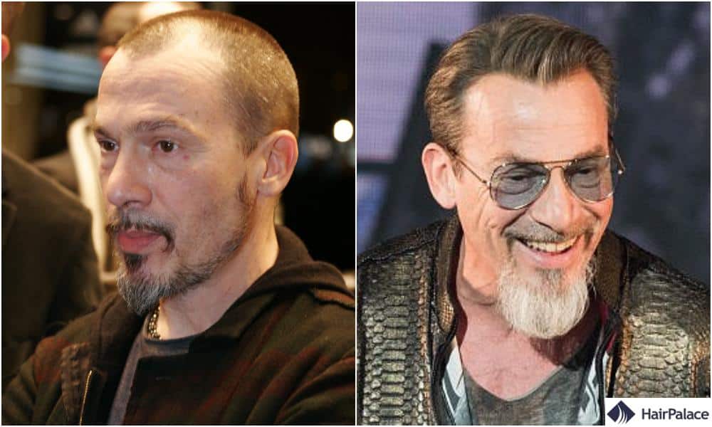 Florent Pagny Cheveux  Tout sur son Implant Capillaire