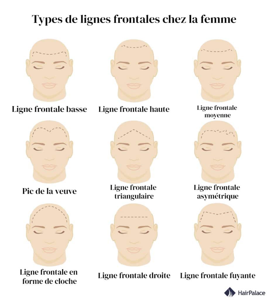 Types de lignes frontales chez la femme